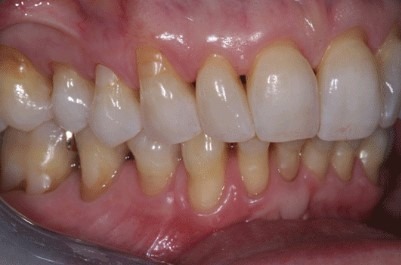 Brad-Lockhart-Pinhole-Gum-Surgery-before-2c