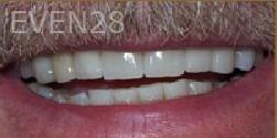 Carey-Penrod-Dental-Crowns-after-1b