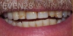 Carey-Penrod-Dental-Crowns-before-1b