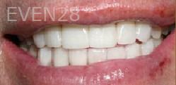 Carey-Penrod-Full-Mouth-Reconstruction-after-2b
