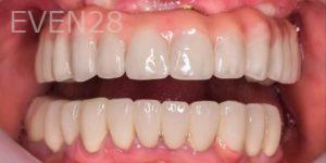 Carlos-Parajon-All-on-Six-Dental-Implants-after-1
