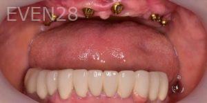 Carlos-Parajon-All-on-Six-Dental-Implants-before-1