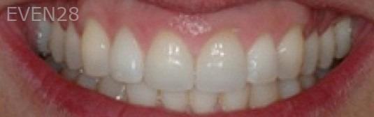 Carlos-Parajon-Dental-Crowns-after-2