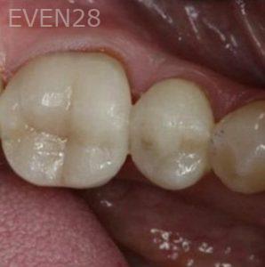 Aria-Irvani-After-Dental-Implants-13