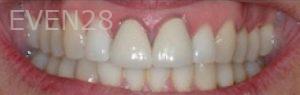 Carlos-Parajon-Dental-Crowns-before-2