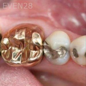 Carlos-Parajon-Dental-Crowns-before-3