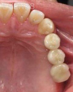Carlos-Parajon-Dental-Implants-after-1