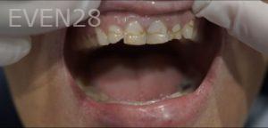 Chris-Nguyen-Dental-Bonding-before-1