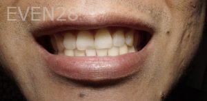 Chris-Nguyen-Dental-Bonding-before-2