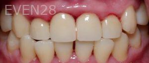 Chris-Nguyen-Dental-Crowns-after-1