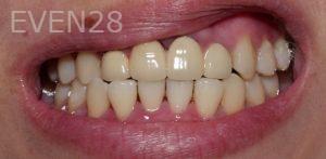 Chris-Nguyen-Dental-Crowns-before-1