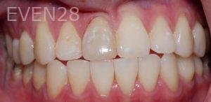 Chris-Nguyen-Dental-Crowns-before-2