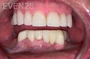 Chrisopher-Andonian-Dental-Crowns-after-1