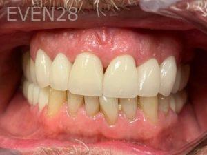 Chrisopher-Andonian-Dental-Crowns-after-2