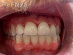 Chrisopher-Andonian-Dental-Crowns-after-4