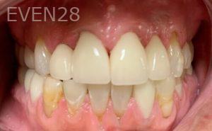 Chrisopher-Andonian-Dental-Crowns-after-5