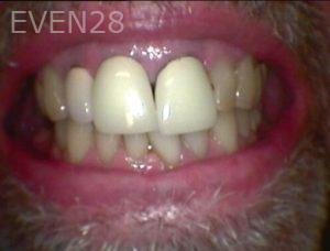 Chrisopher-Andonian-Dental-Crowns-before-2