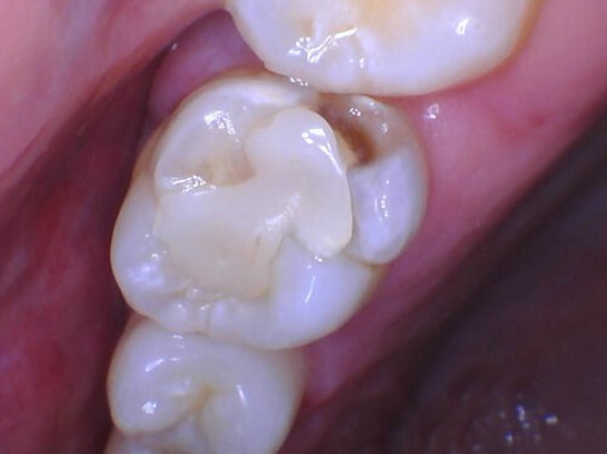 Chrisopher-Andonian-Dental-Crowns-before-3