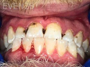 Chrisopher-Andonian-Dental-Crowns-before-4
