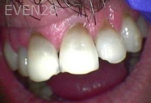 Chrisopher-Andonian-Dental-Crowns-before-5
