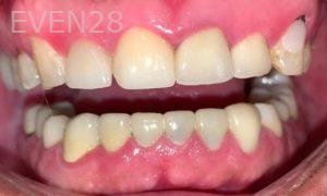 Chrisopher-Andonian-Dental-Implants-after-1