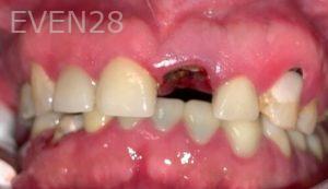 Chrisopher-Andonian-Dental-Implants-before-1