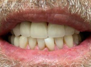 Chrisopher-Andonian-Teeth-Whitening-after-1