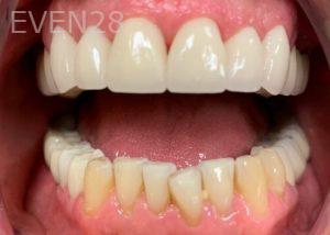 Chrisopher-Andonian-Teeth-Whitening-before-1