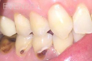 Chrisopher-Andonian-White-Fillings-after-1