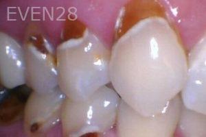 Chrisopher-Andonian-White-Fillings-before-1
