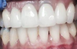 Clara-Nguyen-Dental-Crowns-after-1