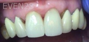 Clara-Nguyen-Dental-Crowns-after-2