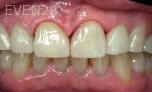 Clara-Nguyen-Dental-Crowns-after-3