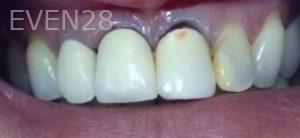 Clara-Nguyen-Dental-Crowns-before-1