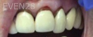 Clara-Nguyen-Dental-Crowns-before-2