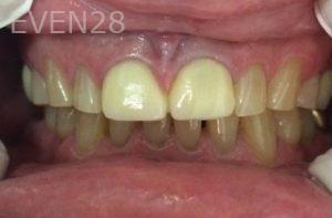 Clara-Nguyen-Dental-Crowns-before-3