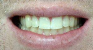 Clara-Nguyen-Teeth-Whitening-before-1