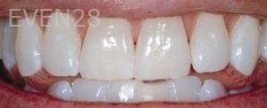 David-Buchan-Teeth-Whitening-after-1