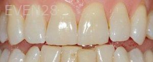 David-Buchan-Teeth-Whitening-before-1