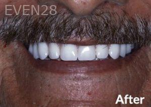Dean-Garica-All-on-Four-Dental-Implants-after-1