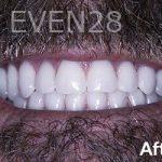 Dean-Garica-All-on-Four-Dental-Implants-after-3