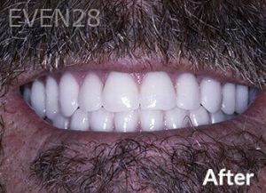 Dean-Garica-All-on-Four-Dental-Implants-after-3