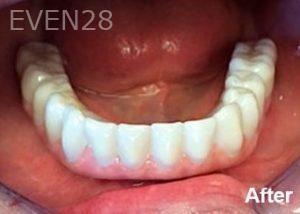 Dean-Garica-All-on-Four-Dental-Implants-after-4