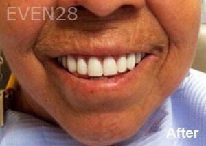 Dean-Garica-All-on-Four-Dental-Implants-after-5