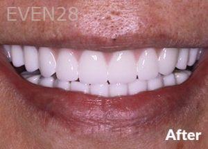 Dean-Garica-All-on-Four-Dental-Implants-after-6