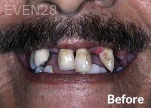 Dean-Garica-All-on-Four-Dental-Implants-before-1