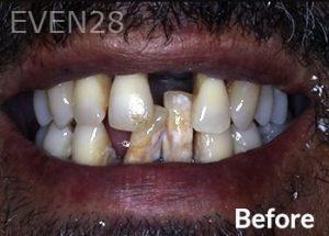 Dean-Garica-All-on-Four-Dental-Implants-before-2