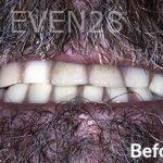 Dean-Garica-All-on-Four-Dental-Implants-before-3