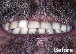 Dean-Garica-All-on-Four-Dental-Implants-before-3