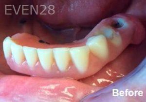 Dean-Garica-All-on-Four-Dental-Implants-before-4